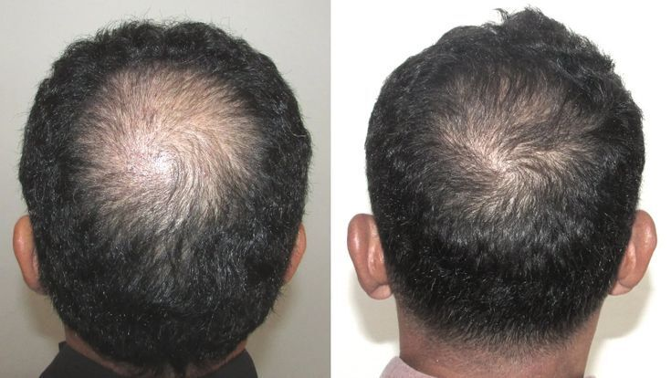 Laser Therapy Before After